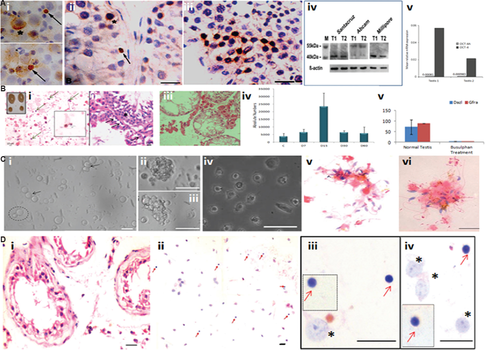 Testicular stem cells, effect of oncotherapy and in vitro culture. (A) Nuclear octamer-binding transcription-4 (OCT-4) expressing small-sized spherical stem cells (SSCs) (arrow) exist along with slightly bigger cells with cytoplasmic OCT-4 (asterix) in (i) testicular cell smears, and (ii) testicular sections, (iii) the bigger sized SSCs undergo clonal expansion implying rapid cell division with incomplete cytokinesis, (iv) testicular tissue was studied for OCT-4 expression by Western blotting using three different commercial antibodies. Santa Cruz and Millipore antibodies were specific to OCT-4A whereas Abcam antibody detected both alternatively spliced isoforms OCT-4A and B. (v) relative expression of Oct-4A and Oct-4B (alternately spliced isoforms of OCT-4 of which OCT-4A is alone responsible for pluripotent state whereas OCT-4B is suggestive of cells entering differentiation) was studied by quantitative reverse transcription-polymerase chain reaction for relative mRNA expression normalized to 18S RNA. As evident, Oct-4A is very less compared to OCT-4 (Oct-4A and B). T1 and T2 are two different testicular tissue samples obtained from men undergoing orchidectomy to manage prostate cancer. Source: Reproduced with permission from Ref. 49. (B) (i) Effect of busulfan treatment (25 mg/kg) on mouse testis. Inset shows the effect of treatment on testes which appear to shrink in size and reduce in weight by 4 wk after chemoablation; H&E stained cell smear on day 15 after treatment shows presence of small sized spherical putative stem cells (<5 μm) with high nucleo-cytoplasmic ratio marked by arrows, (ii) testis sections prepared on day 15 after busulfan treatment show the presence of small spherical stem cells along the basement membrane of the seminiferous tubules marked by arrows, (iii) by day 30, the seminiferous tubules get devoid of germ cells, (iv) flow cytometry data enumerating absolute number of VSELs on different days after busulfan treatment show that initially, the number of VSELs increases on day 15 and later reduce but they do survive till day 30. (v) Reverse transcription-polymerase chain reaction for germ cell markers - Dazl and Gfra shows marked reduction of these transcripts on day 30 in agreement with histological data shown in (iii). Source: Reproduced with permission from Refs 5051. (C) In vitro culture of cells isolated from chemoablated seminiferous tubules. (i) Testicular stem cells that survive chemotherapy remain non-adherent and semi-attached on top of a feeder made by the Sertoli cells that get attached to the culture surface. The smaller VSEL divide and give rise to a slightly bigger SSC (broken circle) whereas the SSC divides rapidly and forms chains (arrow), and (ii & iii) clusters. These cells undergo differentiation to form (iv) spermatids, and (v & vi) sperm. Source: Reproduced with permission from Ref. 52. (D) Azoospermic human testicular biopsies of cancer survivors of childhood cancer harbour stem cells. (i) H&E stained testicular sections show azoospermia and complete lack of germ cells, (ii) testicular smears show presence of small, spherical putative stem cells, (iii & iv) higher magnification of smears showing Sertoli cells (*) and VSELs (red arrow) that survive oncotherapy in seminiferous tubules. VSELs are spherical in shape with minimal cytoplasm whereas Sertoli cells are characterized by a large nucleus with prominent nucleoli. Insets include VSELs captured from different microscopic fields. Source: Reproduced with permission from Ref. 53.